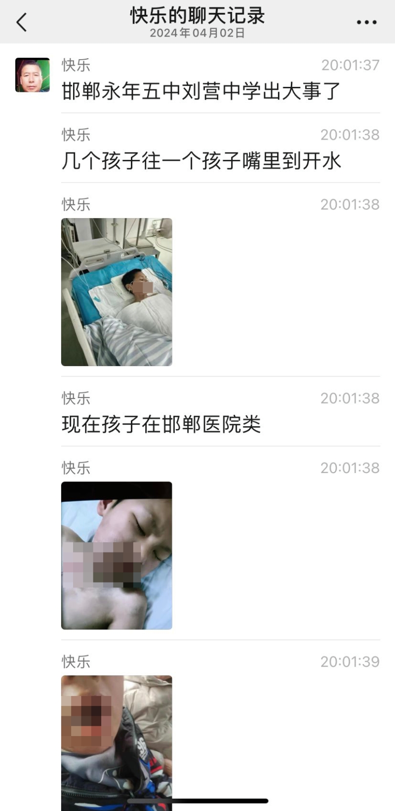 邯鄲初中生被人灌滾水受傷事件曝光