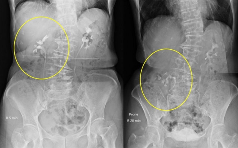 游離腎患者的腎臟會「移位」，引起腰痠腰痛、尿頻等癥狀。（相片來源：呂謹亨醫生Facebook專頁）